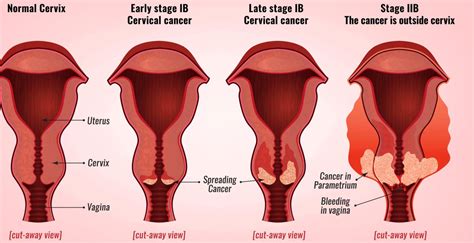 Cervical Cancer Stages Yourcareeverywhere