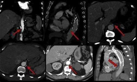 The Results And Rationale Of Tevar Procedure For Type B Intramural