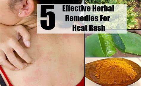5 Effective Herbal Remedies For Heat Rash Mzizi Mkavu
