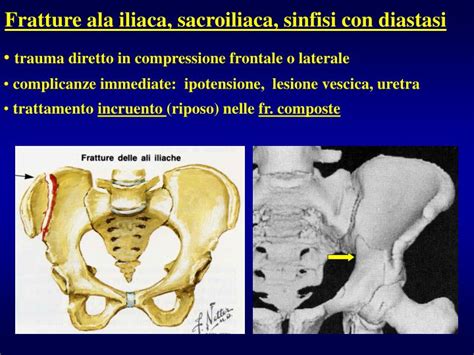 PPT - Fratture bacino PowerPoint Presentation - ID:5091197