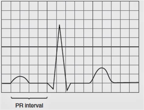 Akhir gelombang qrs (j point) sampai dengan awal gelombang qrs t. Interpretasi EKG 5 Langkah
