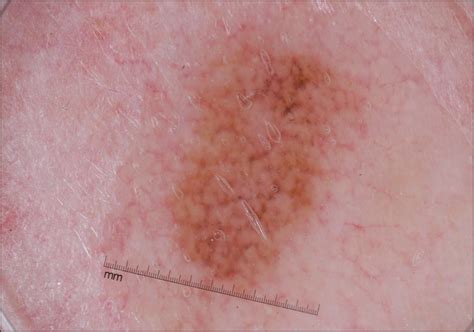 The Zig Zag Pattern Of Lentigo Maligna Dermatology Jama Dermatology