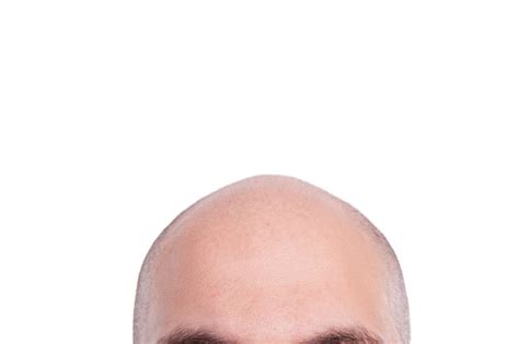 Completely Bald Man Head Stock Photo Download Image Now Istock