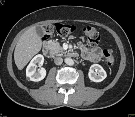 Neuroendocrine Tumor Pancreas Pancreas Case Studies Ctisus Ct Scanning