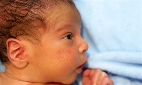 Common Baby Skin Conditions Detroit And Ann Arbor Metro Parent