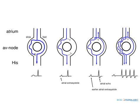 Mechanisms Of Arrhythmias Ecgpedia