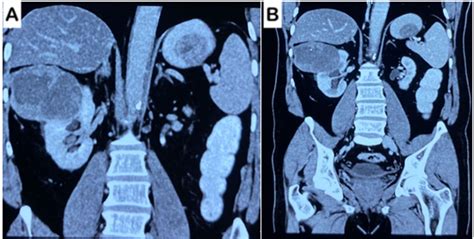 Renal Cell Cancer With Solitary Gastric Metastasis A Rare Presentation