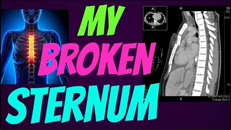 How I Broke My Sternum Life After A Spinal Cord Injury Youtube