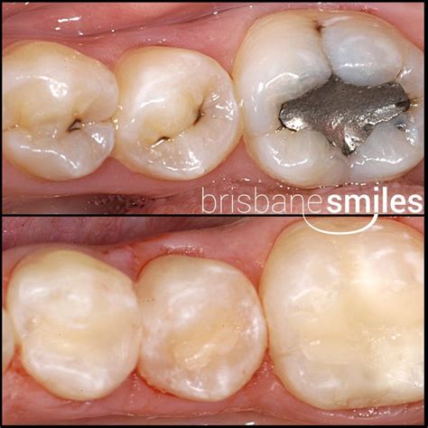 White Fillings General Dentistry Brisbane Smiles