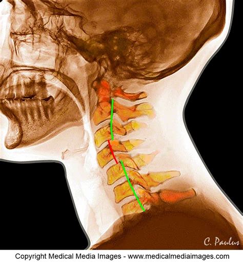 Chiropractic Color X Ray Showing A Chiropractic Cervical Subluxation