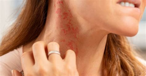 An Introduction To The Types Of Itchy Skin Rashes The
