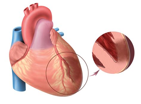 Common causes of ischemia are: Myocardial infarction