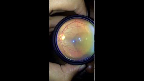 Fundus Video With The Help Of 22 20d Pan Retinal Lens And Iphone