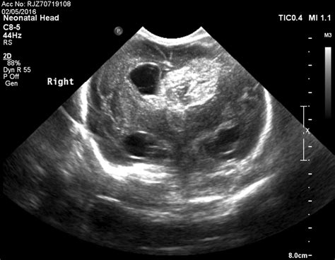 Neonatal Hydrocephalus Ultrasound