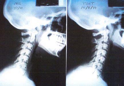 También puede causar compresiones en la médula, de carácter más o menos grave. Nuestro esqueleto: Cabeza y cuello: Latigazo cervical.