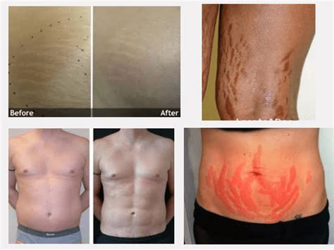 Laser Stretch Mark Removal The Advanced Way Of Removing Stretch Marks