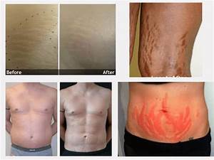 Laser Stretch Mark Removal The Advanced Way Of Removing