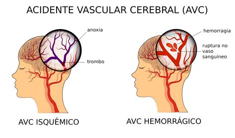 Acidente Vascular Cerebral Avc Tipos Causas Sintomas Infoescola