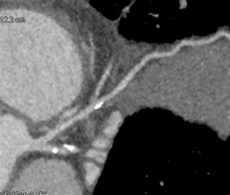 Which Test To Assess Coronary Arteries In The Over 40s Medical Forum