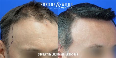 This means that it is not very invasive and that it will leave minimal to no scarring. 4303 FUE Hair Transplant Grafts | Before & After FUE Hair ...