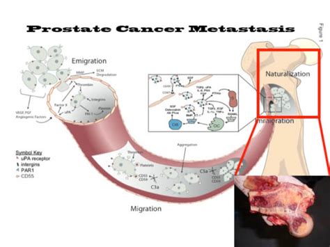 Prostate Most Cancers Bone Marrow Metastasis
