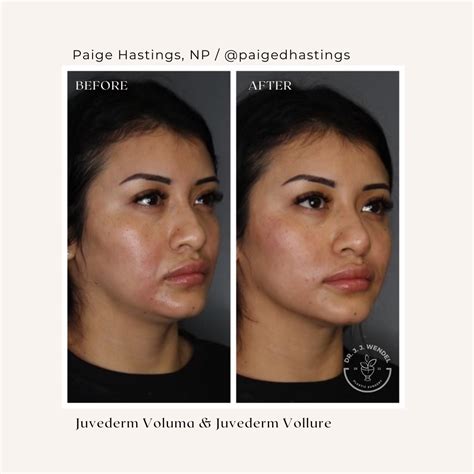 This Patient Is Shown Before And Immediately After One Syringe Of