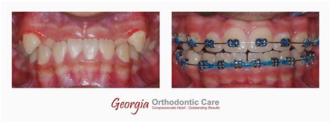 Georgia Orthodontic Care Lawrenceville And Norcross Ga December 2014