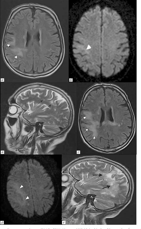 Figure From The Predictive Power Of Mri Criteria In The Diagnosis Of