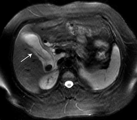 Mr Imaging Of The Gallbladder A Pictorial Essay Radiographics