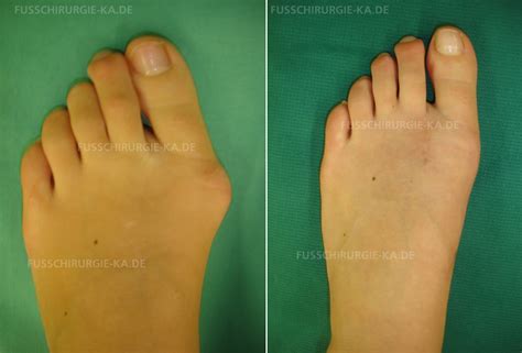 Fuß Und Sprunggelenkschirurgie