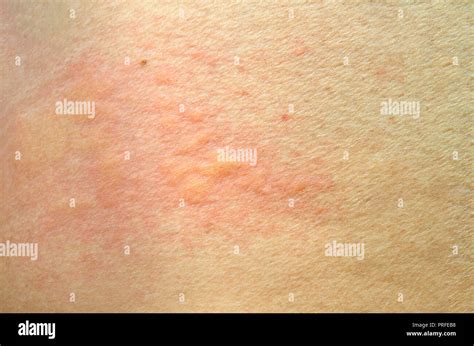 Skin Rash Urticaria Allergic Skin Reaction Stock Photo Alamy
