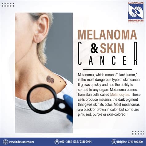 Melanoma And Skin Cancer Causes And Risk Factors Symptoms And Detection Diagnosis And