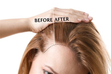 Alopecia Areata Hair Loss Men And Women Causes Houston Tx Dermatologist