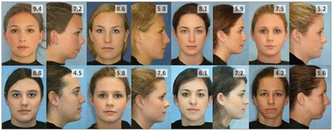 association of frontal and lateral facial attractiveness jama facial plastic surgery
