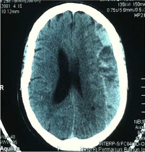 Computed Tomography Scan Showing Left Acute Or Chronic Subdural