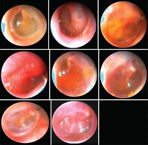 Correlation Between Video Otoscopic Images And Tympanograms Of Patients