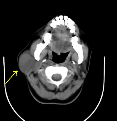 First Branchial Cleft Cyst Ct Sumers Radiology Blog