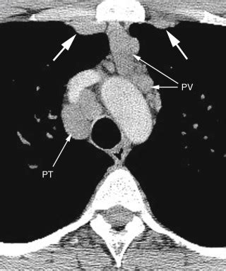 Mediastinum: Lymph Node Abnormalities and Masses | Radiology Key