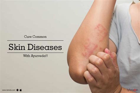 Cure Common Skin Diseases With Ayurveda By Dr K D Lybrate