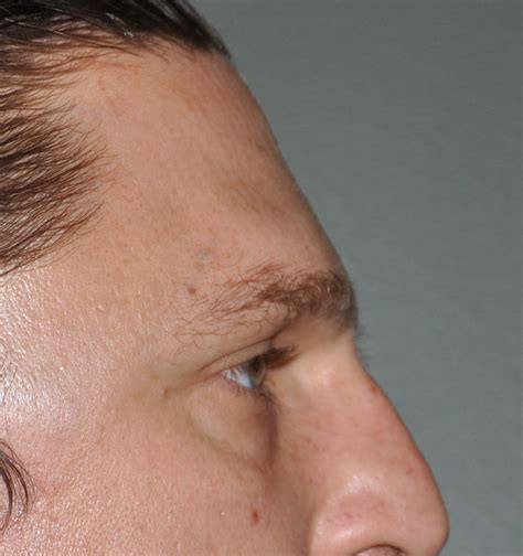 Brow Boneforehead Reduction Sugeon Dr Barry Eppley