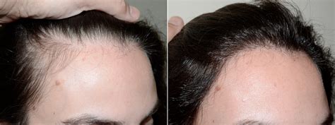 Hair Restoration For Women What You Need To Know In 2023 ~ All About Best Hair Restoration