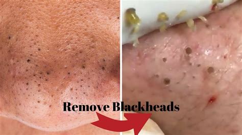 Remove Your Blackheads Using These Techniques Naturally Home Remedies