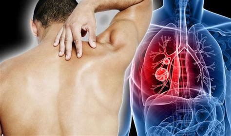 Lung Cancer Symptoms Signs Of A Tumour Include Lower Back Pain When