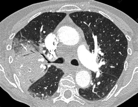 Lobar Pneumonia Lung Ct Scan Stock Image C0384540 Science Photo
