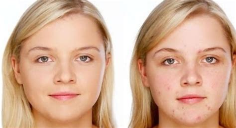 Bintik merah pada kulit disertai gatal sering terjadi di area wajah, lengan dan kaki. Cara Menghilangkan Bintik Bintik Merah Di Wajah Dengan ...