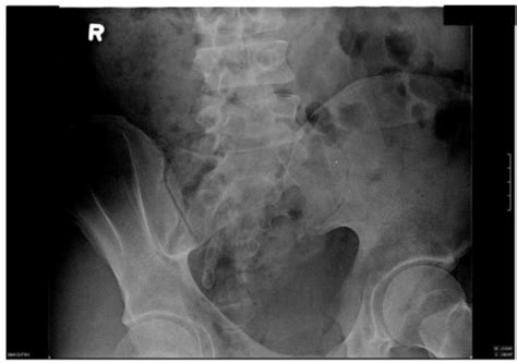 Sacroiliac Joints X Ray Showing Narrowing And Irregular Open I