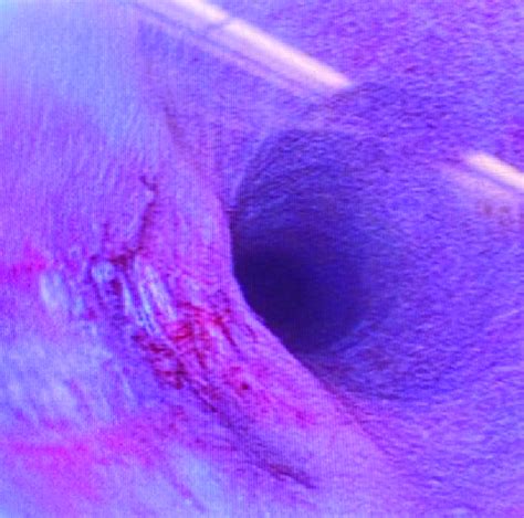 Cystoscopy Image Demonstrating A Longitudinal Tear In The Distal