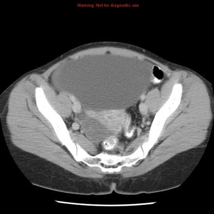 Ovarian Epithelial Tumors Radiology Reference Article Radiopaedia Org