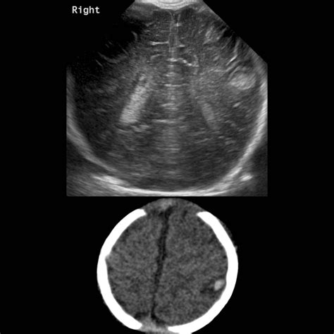 Newborn With A Full Fontanelle Pediatric Radiology Case Pediatric