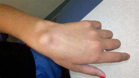 Ganglion Cyst At Wrist Foot Pictures Causes Treatment Removal My XXX